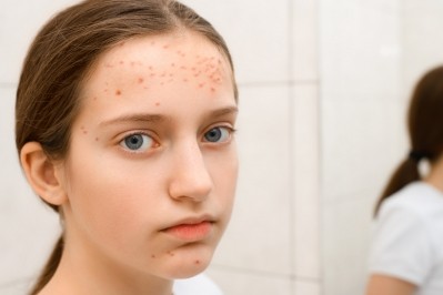 CeraVe Acne Survey © soleg Getty Images